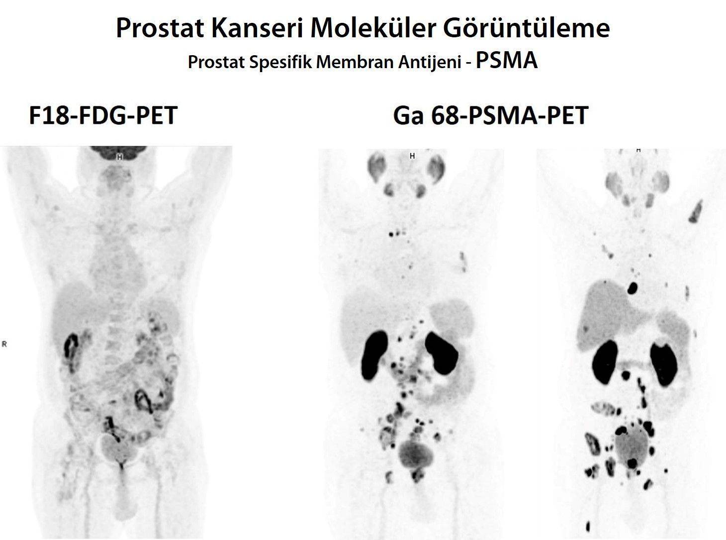 Prostat Kanseri Prostat Kanseri