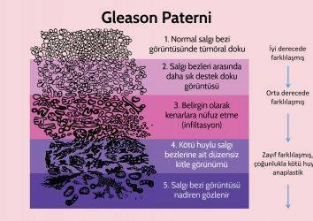 Gleason skoru nedir? Prostat kanserinde gleason dereceleri nasıl hesaplanır?