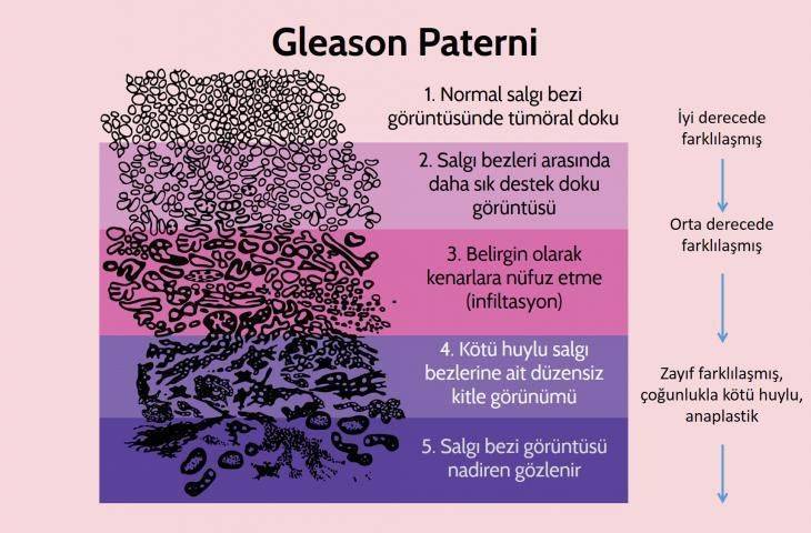 Prostat kanserinde doğru tedavi için bu alanda uzman patologlardan ikinci görüş alınmalı mıdır?