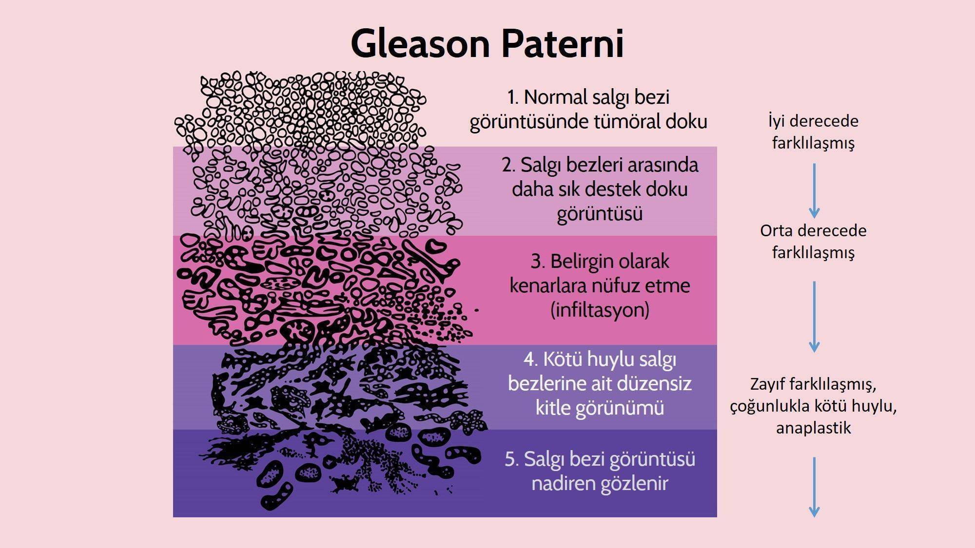 Prostat Kanseri Belirtileri Ve Tedavisi Prostat Kanseri Belirtileri Ve Tedavisi
