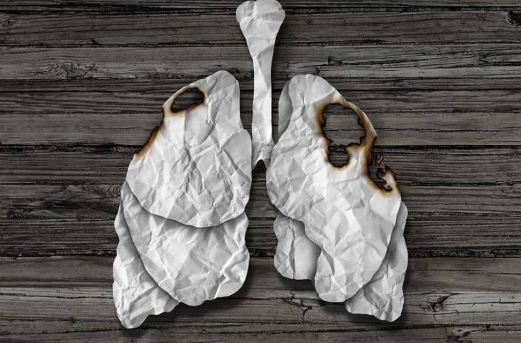 SBRT: Erken evre akciğer kanserinde tek seçenek ameliyat mı?