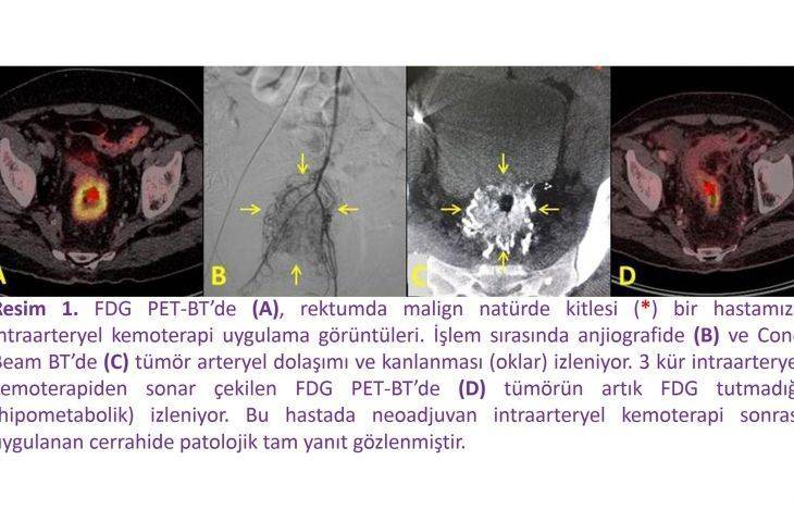 Rektum kanserinde intraarteryel kemoterapi sonuçlarımız
