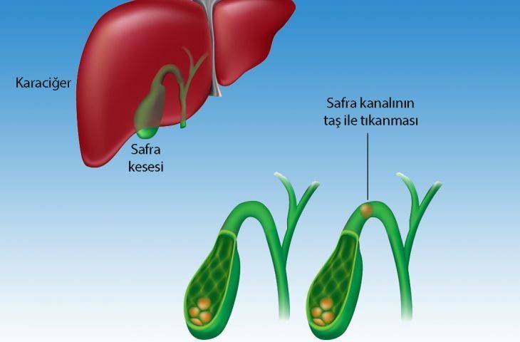 Safra kanalı taşı hastalığı koledokolitiazis belirtileri ve tedavisi