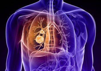 Sigara Dışı Akciğer Kanseri Nedenleri