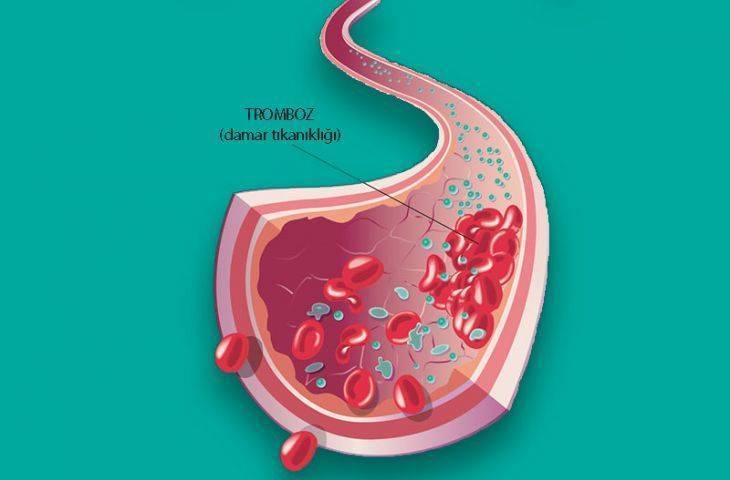 Toplardamar tıkanıklığı - venöz tromboemboli için yeni bir kan sulandırıcı FDA onayı aldı