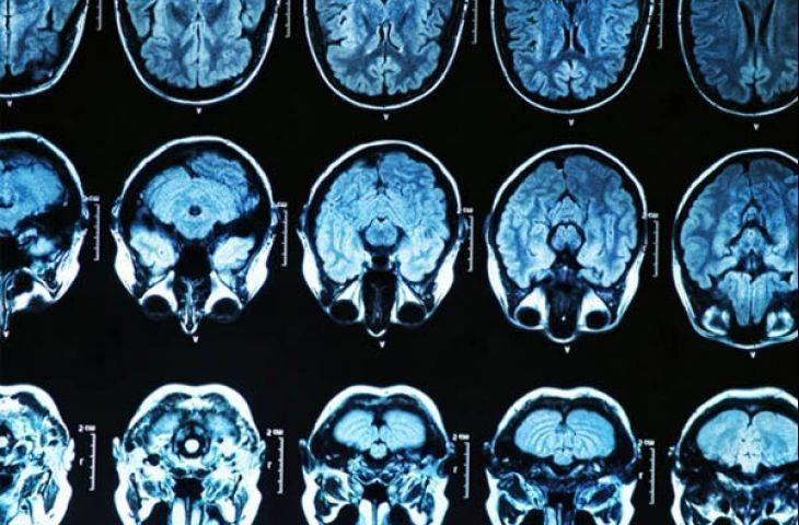 Yeni teşhis edilmiş glioblastomda bevasizumab radyoterapi ve temozolomid ile birlikte verildiğinde etkili olur mu?