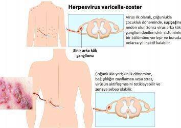 Zona Hastalığı Nedir? Belirtileri Nelerdir? Yeni Bir Aşı ile Zonadan Korunmak Artık Mümkün