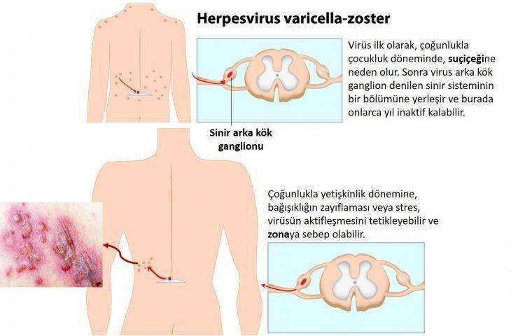 Zona Hastalığı Nedir? Belirtileri Nelerdir? Yeni Bir Aşı ile Zonadan Korunmak Artık Mümkün