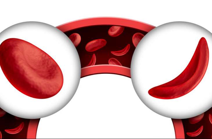 Orak hücreli anemi tedavisi için ilk kez bir ilaç FDA onayı aldı!