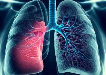 Akciğer Kanseri Tedavisinde Yeni Adım – Mediastinoskopi Olmaksızın Tümör Çıkarılması