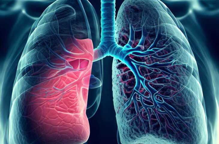 Akciğer Kanseri Tedavisinde Yeni Adım – Mediastinoskopi Olmaksızın Tümör Çıkarılması