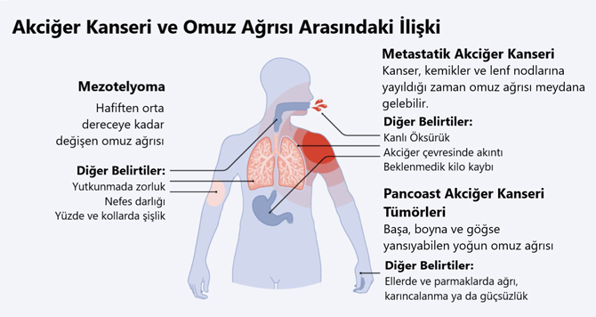 akciger kanseri ve omuz agrisi arasindaki iliski