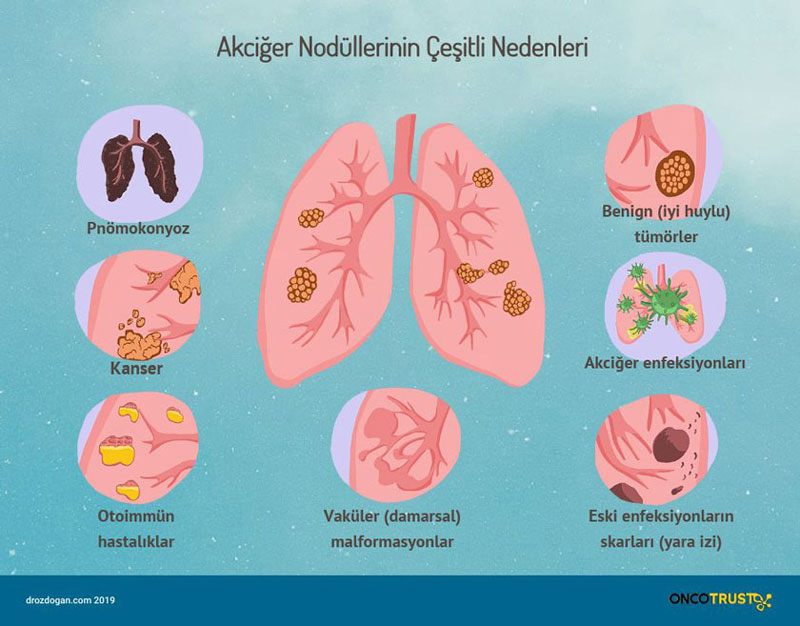 Akciğer nodülü nedir kanser midir tedavisi nasıldır? Prof. Dr. Mustafa ÖZDOĞAN