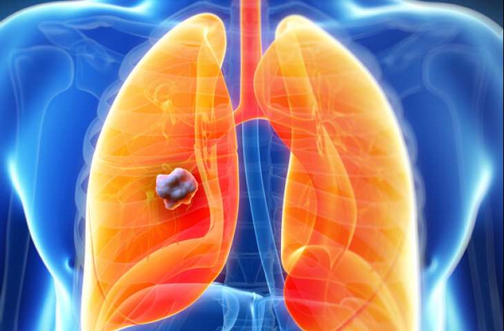 Akciğer nodülü nedir, kanser midir, tedavisi nasıldır?