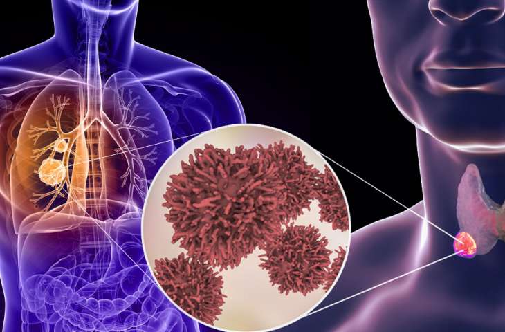 Akciğer ve tiroid kanserlerinde görülebilen RET mutasyonuna yönelik İLK TEDAVİ FDA onayı aldı: Selpercatinib