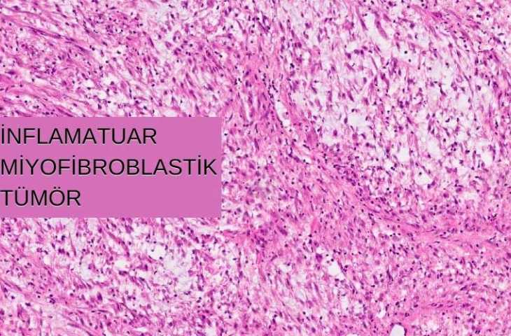 ALK-pozitif İnflamatuar Miyofibroblastik Tümör için Krizotinib FDA Onayı Aldı