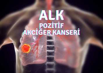 ALK Pozitif Ne Demek? ALK Mutant Akciğer Kanseri Başlangıç Tedavileri Karşılaştırması