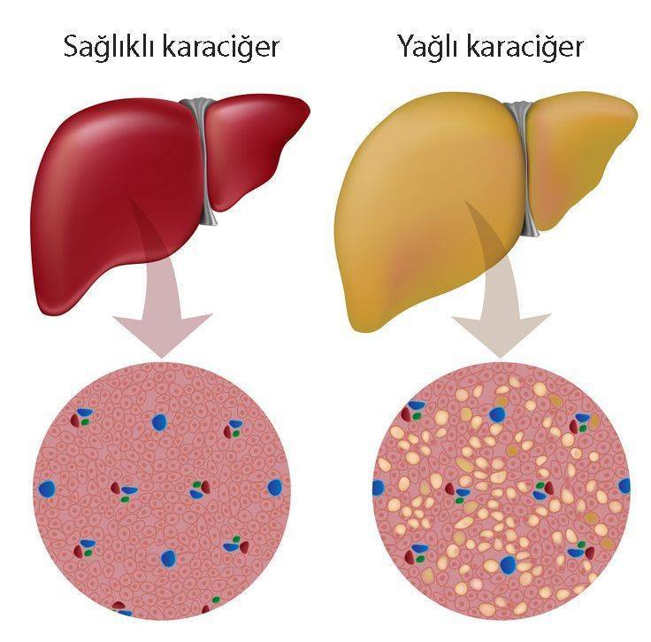 alkole bağlı olmayan karaciğer yağlanması sağlıklı ve yağlı karaciğer farkları