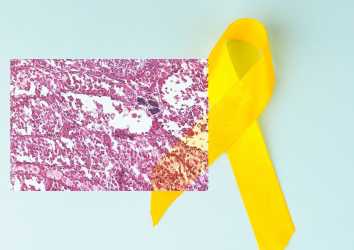Alveolar Yumuşak Doku Sarkomu için Atezolizumab İmmünoterapisi FDA Onayı Aldı