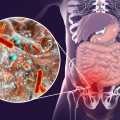 Apendektomi (Apandisit Ameliyatı) Kalın Bağırsak Kanseri Riskini Artırıyor mu?