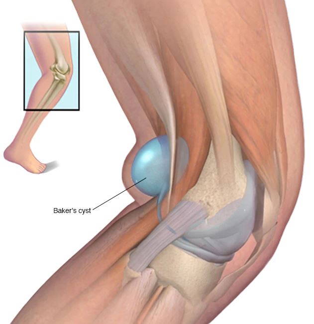 baker popliteal diz kisti nedir