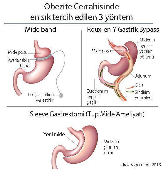 bariatrik cerrahi sleeve gastrektomi çeşitleri tüm mide ameliyatı roux en y gastrik bypass nas�