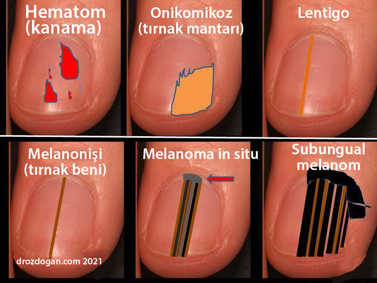 bazı tırnak bozuklukları hematom onikomikoz lentigo melanonişi in situ melanom