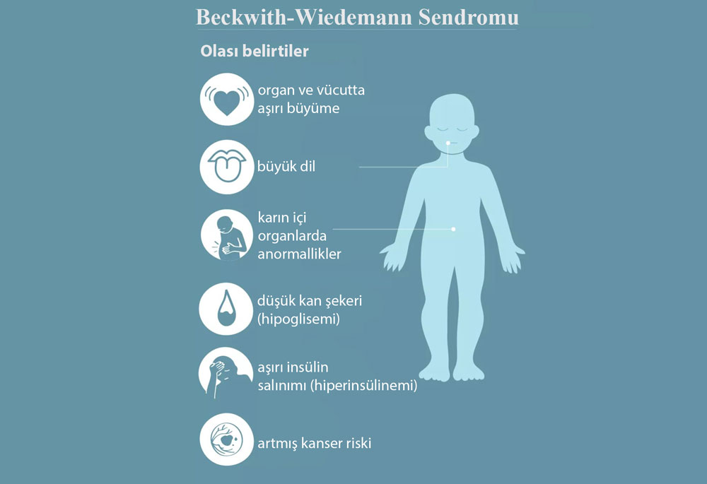 Beckwith Wiedemann Sendromu nedir infografik görsel