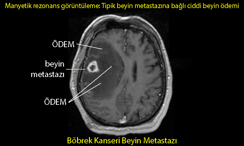 beyin ödemi nedir böbrek kanseri metastazı