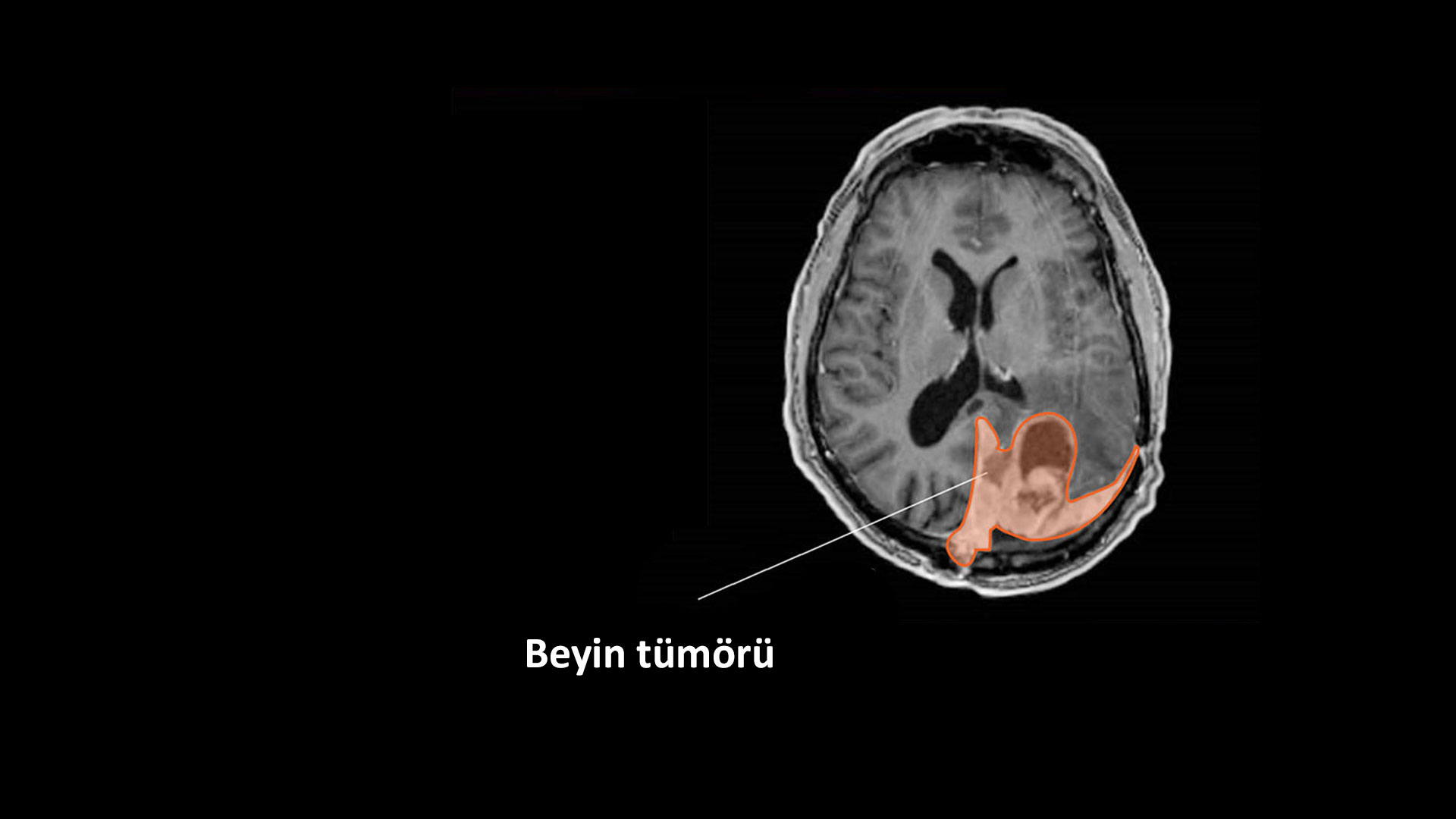 beyindeki meninjiyomun MRG görüntüsü