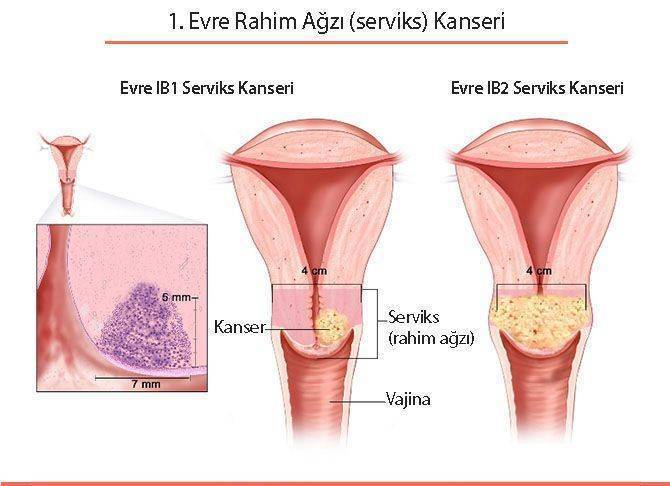 birinci 1 evre rahim ağzı serviks kanseri