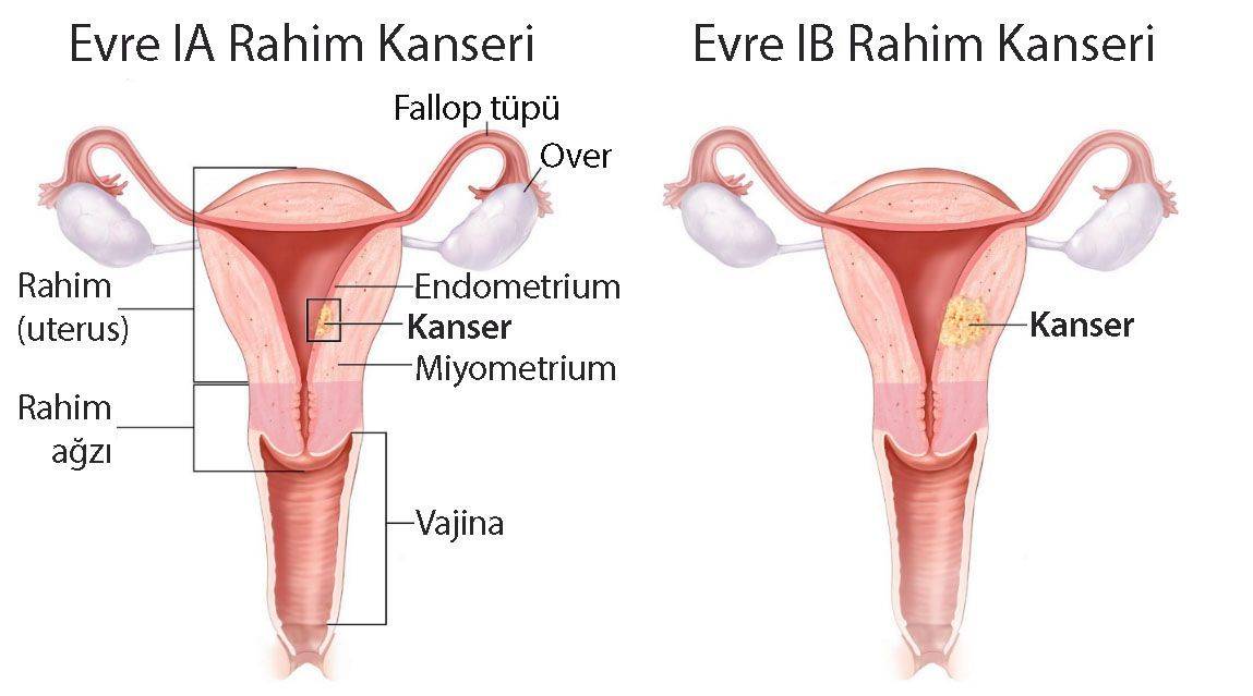 birinci evre rahim kanseri evre 1a ve 1b