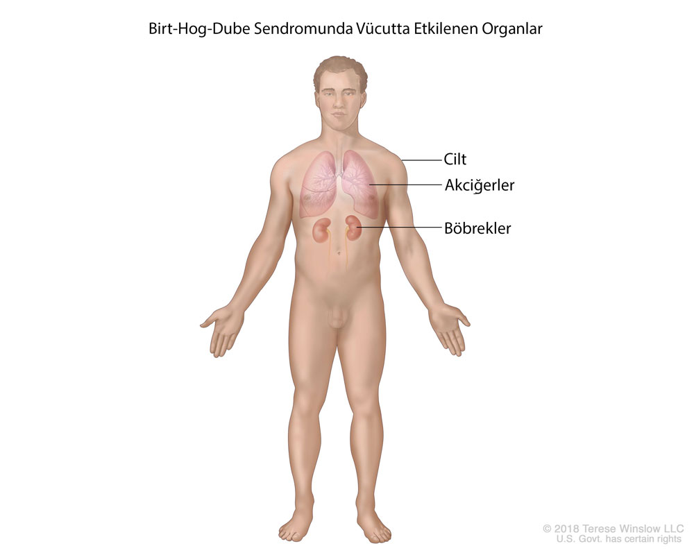 birt hogg dube sendromunda vücutta etkilenen bölgeler organlar
