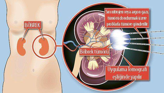 böbrek kanseri tümörü kriyoablasyon dondurma tedavisi