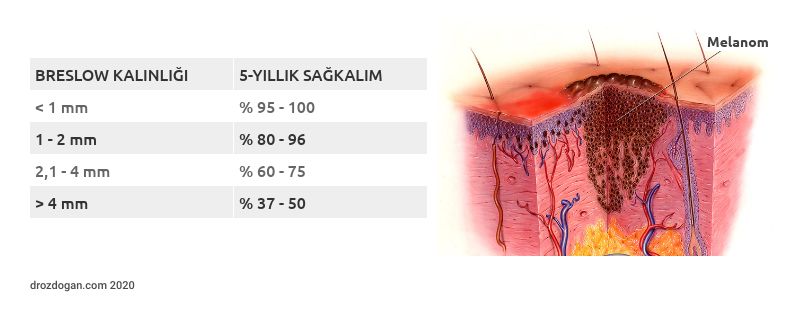 bresloq kalinligi ve sagkalim iliskisi melanom