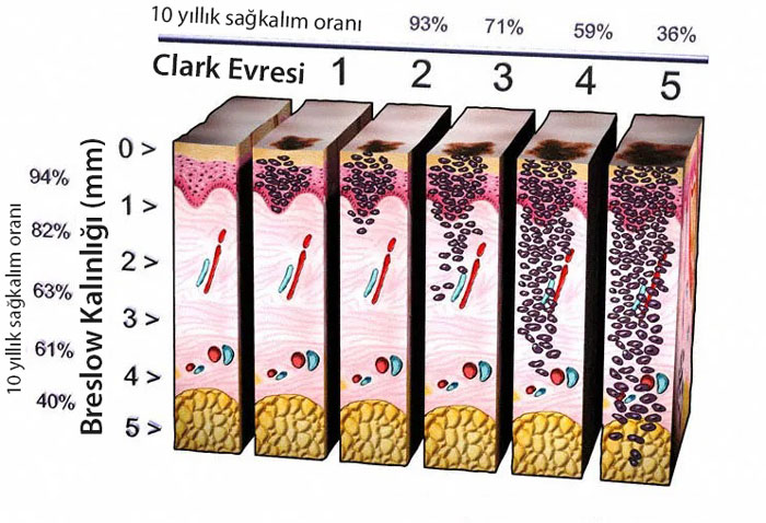 breslow kalınlığı ve clark evresi sağkalım ilişkisi melanom