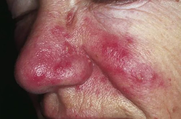 burunda rosacea