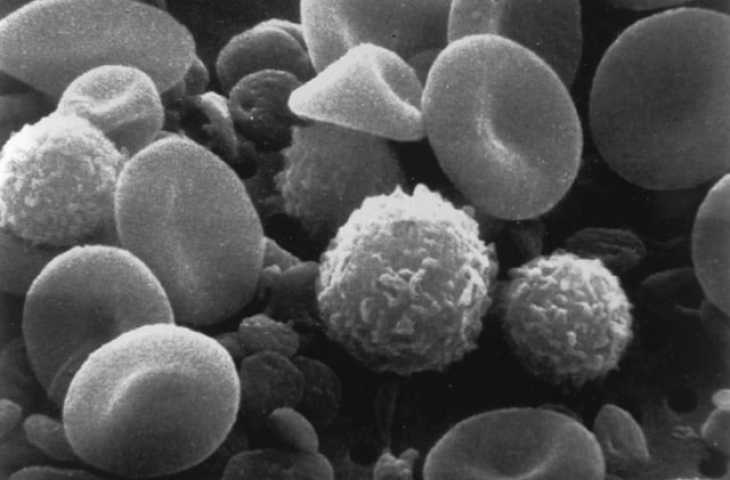 Büyük B Hücreli Lenfoma İkinci Basamak Tedavisinde CAR T-hücre (Yescarta) FDA Onayı Aldı