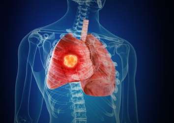 İmmünoterapi kombinasyonu bu kez akciğer kanseri AMELİYAT ÖNCESİ tedavide etkili bulundu
