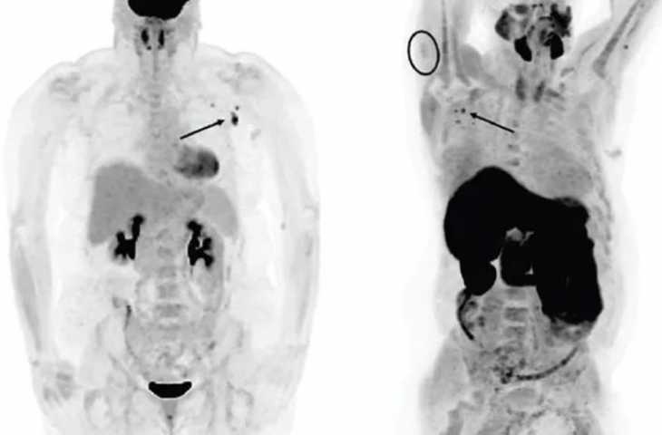 Covid-19 aşısı sonrası PET taramada yanlış pozitif lenf düğümlerine dikkat