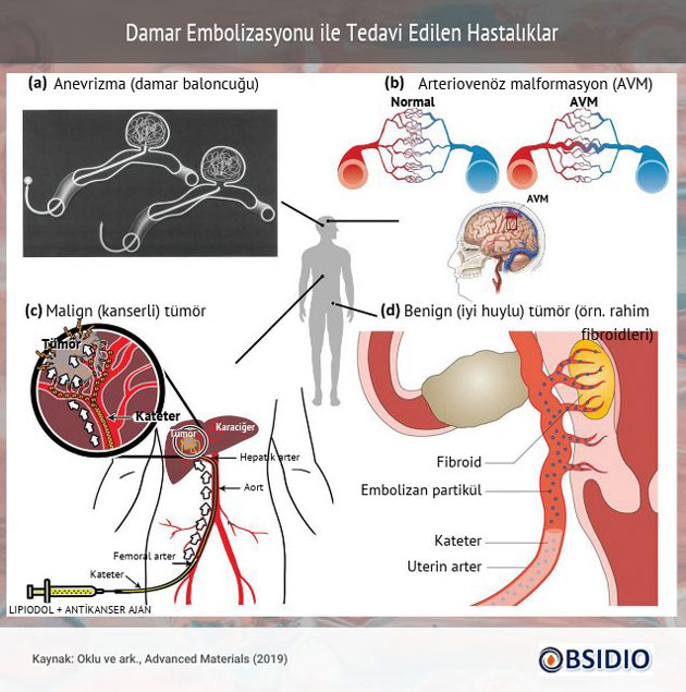 damar embolizasyonu ile tedavi edilen hastaliklar