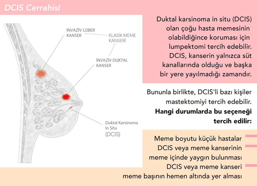 DCIS nedir ameliyatı ne tercih edilmeli