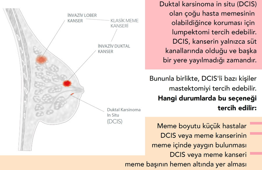 DCIS nedir nasıl tedavi edilir lumpektomi mastektomi