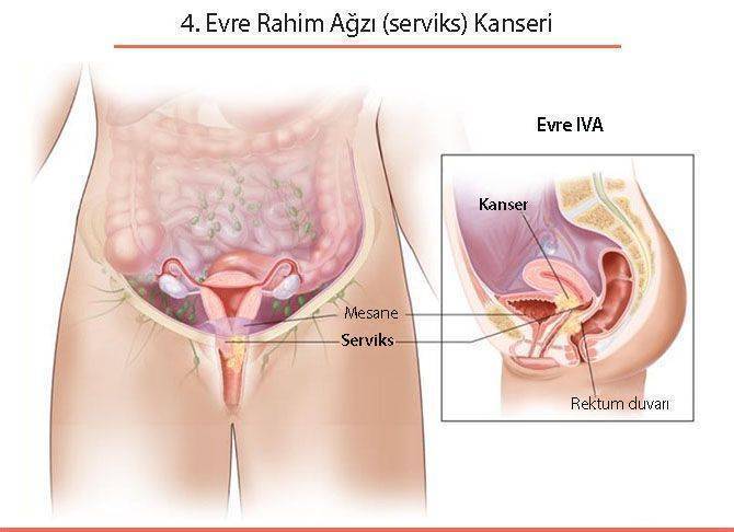 dördüncü evre 4 rahim ağzı serviks kanseri