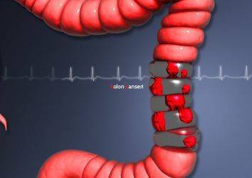 4. Evre Kolon ve Rektum Kanseri İçin Nivolumab FDA Onayı Aldı