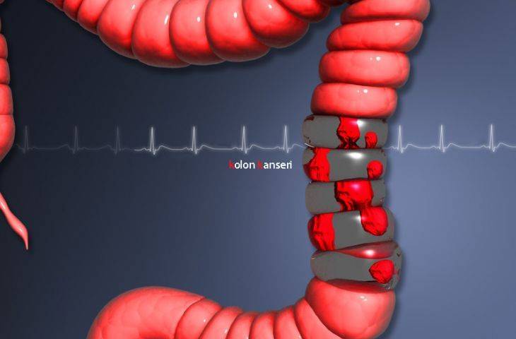 4. evre kolon ve rektum kanseri için nivolumab FDA onayı aldı