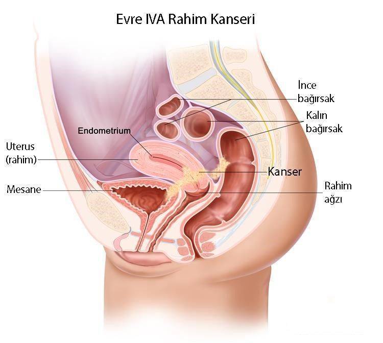 dördüncü evre rahim kanseri evre 4A