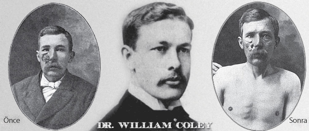 dr william coley kanser immünoterapisinin mucidi tarihi