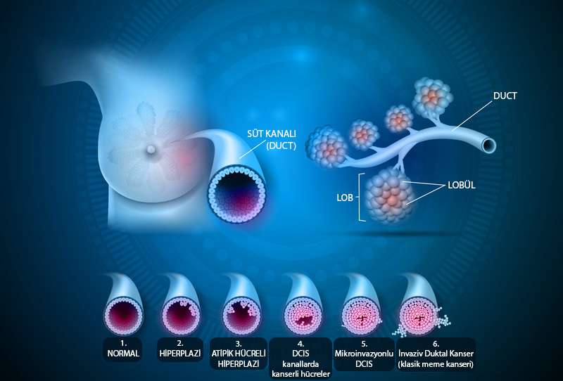 duktal karsinoma in situ dcis nedir