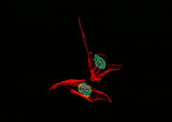 Kanseri Hücrelerinin Tümör Büyümesini Destekleyen Protein Salgıladığı Keşfedildi